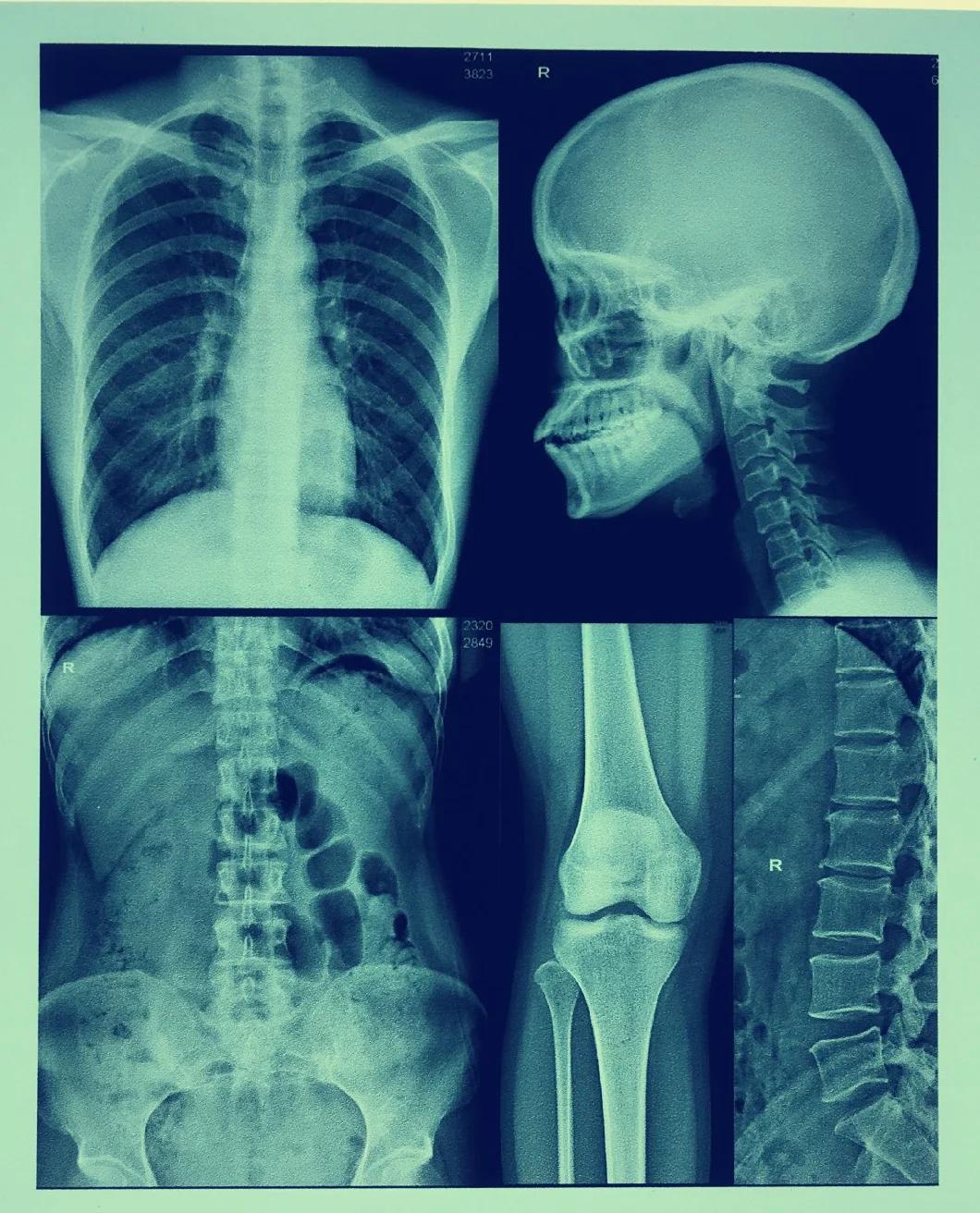 Radiology Department Use 13X17 Inch Thermal X-ray Film