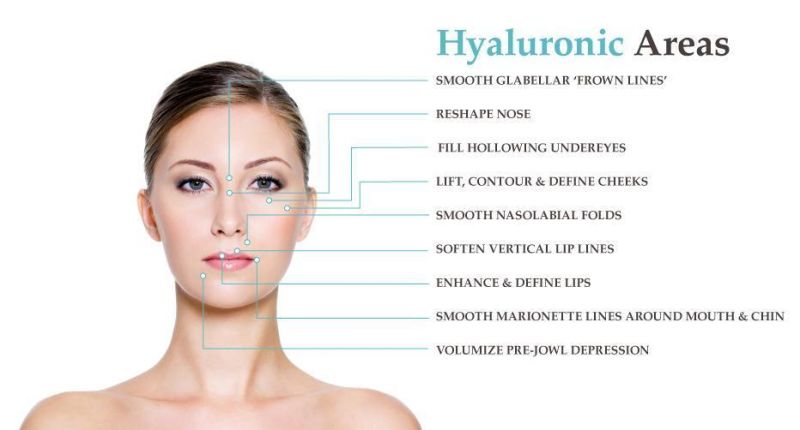 Hyaluronic Acid Injection Dermal Filler with Lidocaine
